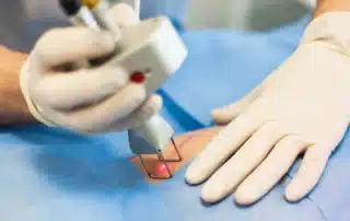 Laser scar removal treatment being performed on a patient, highlighting professional scar reduction services in Lakewood Ranch, FL for smoother, healthier-looking skin.
