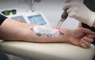 A professional laser tattoo removal treatment in Lakewood Ranch FL
