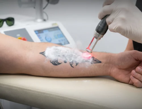 Laser Tattoo Removal in Lakewood Ranch, FL Can Help You Say Goodbye to Unwanted Ink